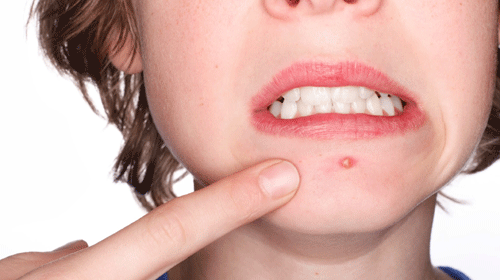 Confira 10 dicas para acabar com as acnes