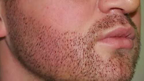 Reprodução - Técnica FUE - Follicular Unit Extraction – utilizado para preencher falhas ou aumentar o volume da barba Reprodução - Técnica FUE - Follicular Unit Extraction – utilizado para preencher falhas ou aumentar o volume da barba