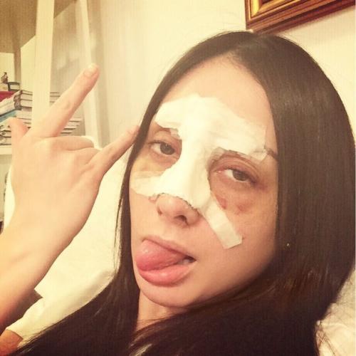 Reprodução/Instagram - A ex-BBB traz um gesso na face que será retirado esta semana Reprodução/Instagram - A ex-BBB traz um gesso na face que será retirado esta semana